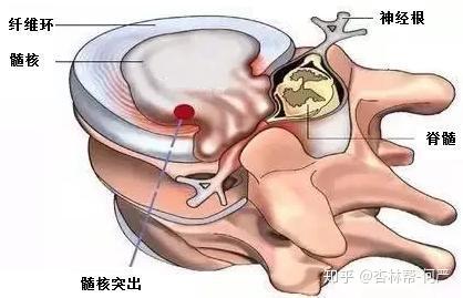 腰椎间盘突出要补钙吗