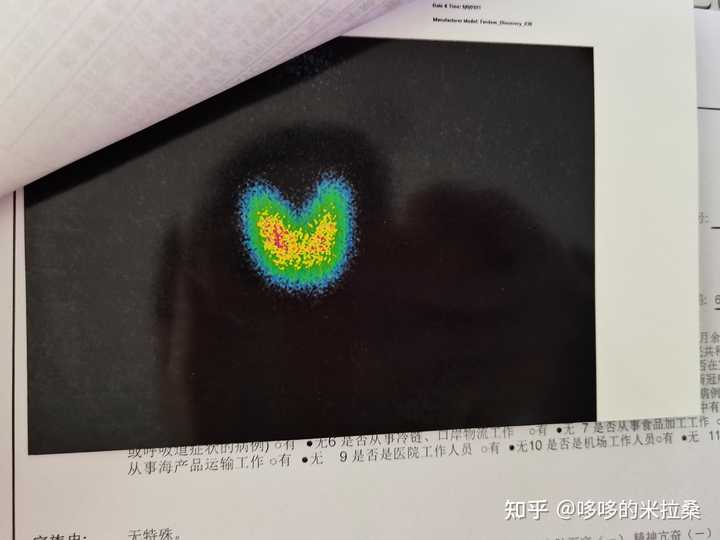 白癜风的人能补硒吗(补硒能预防什么疾?。?硒宝网