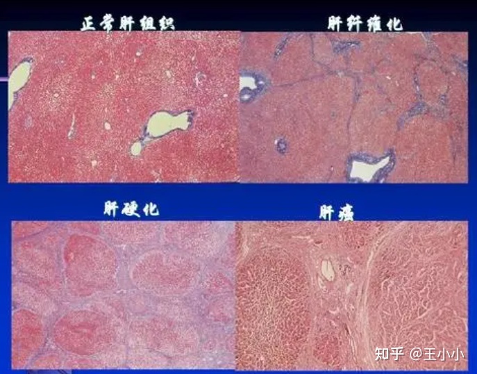 补硒引起ggt升高