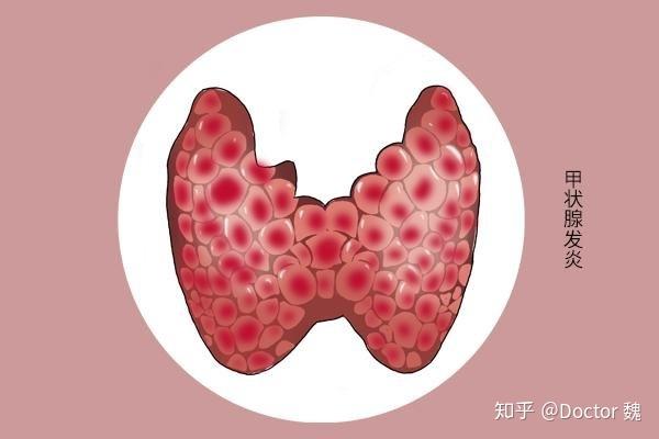 甲亢医生建议补硒吗