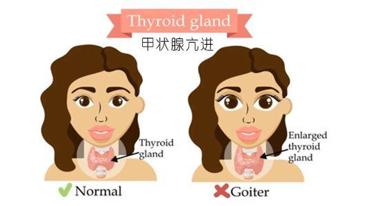 甲状腺激素低补硒吗