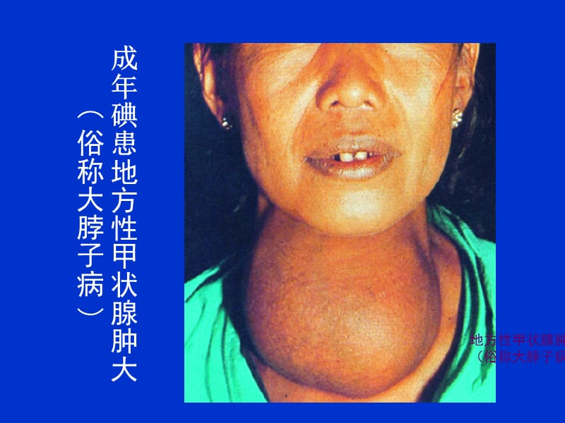 补碘的药
