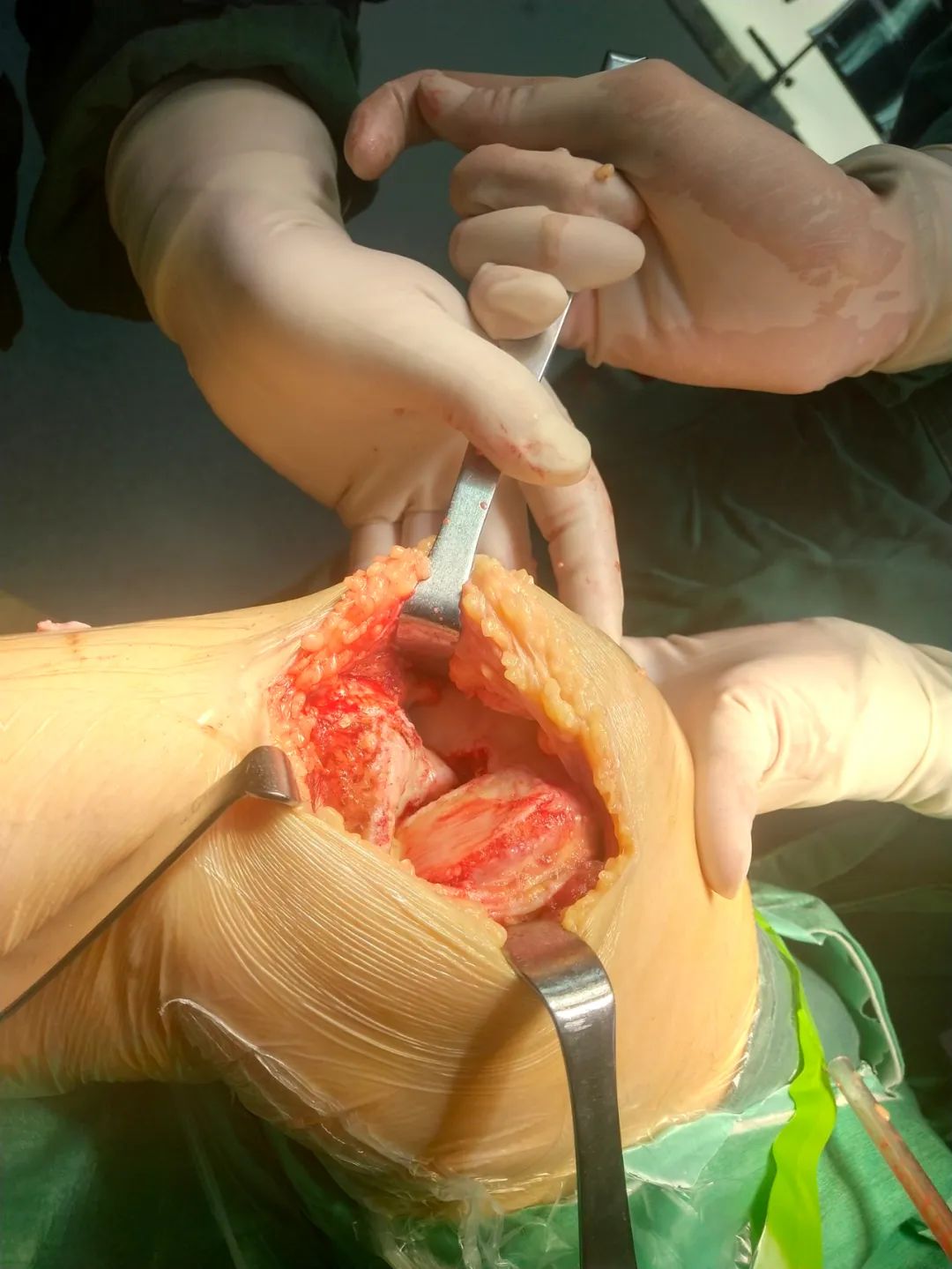 hpv52阳性补硒