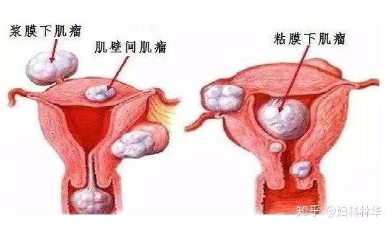 子宫肌瘤需要补硒嘛