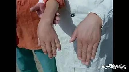 宝宝缺硒怎么补最快(宝宝缺硒会引起哪些疾?。?硒宝网