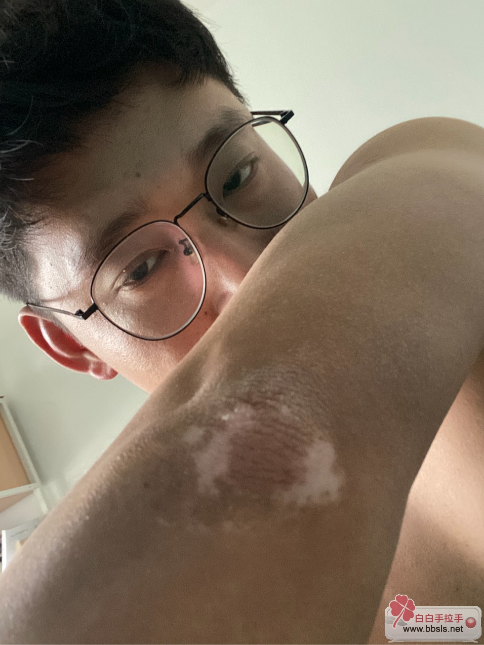 补硒能治疗白癜风吗