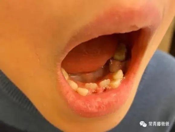 孩子补钙