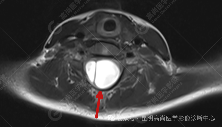 补硒能治疗骶管囊肿(骶管囊肿吃什么药可以让囊变?。?硒宝网