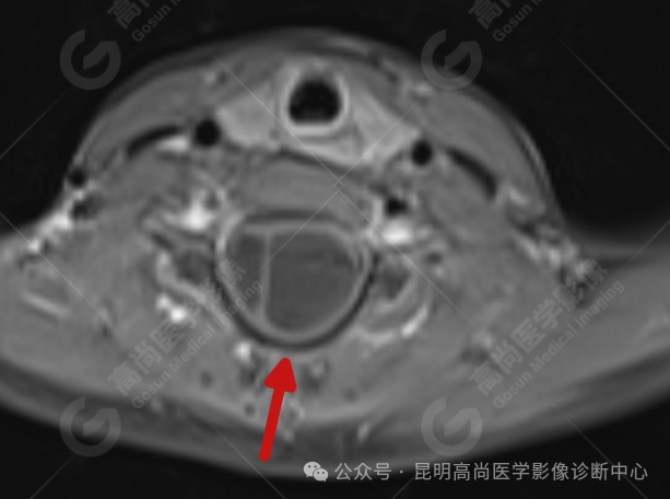 补硒能治疗骶管囊肿(骶管囊肿吃什么药可以让囊变?。?硒宝网