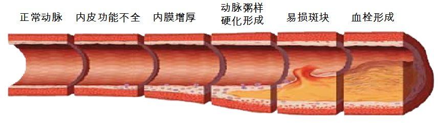 补硒对脑血栓的好处