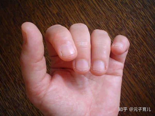 咬指甲缺什么微量元素