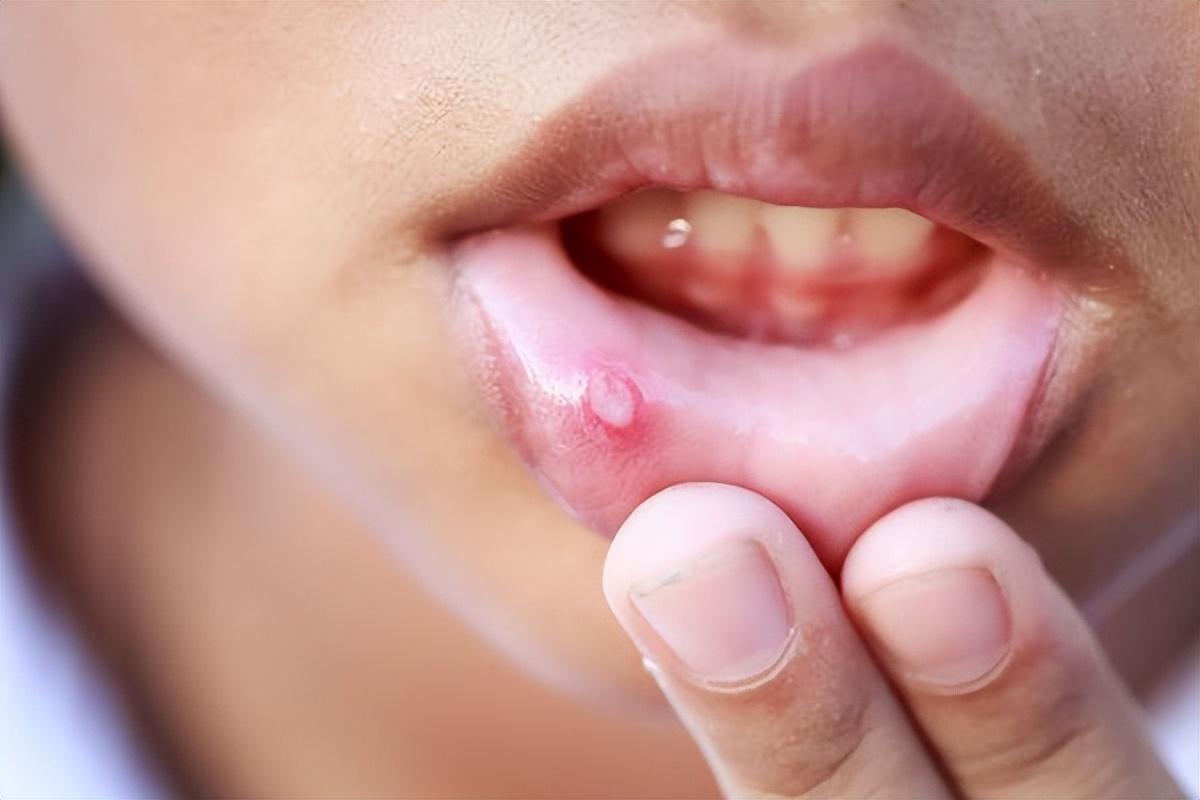 复发性口腔溃疡补硒
