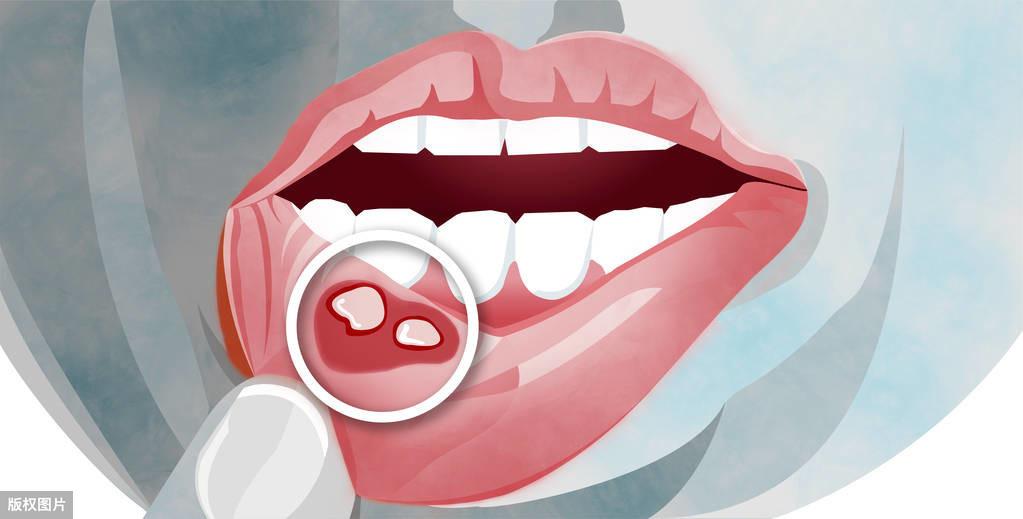 复发性口腔溃疡补硒