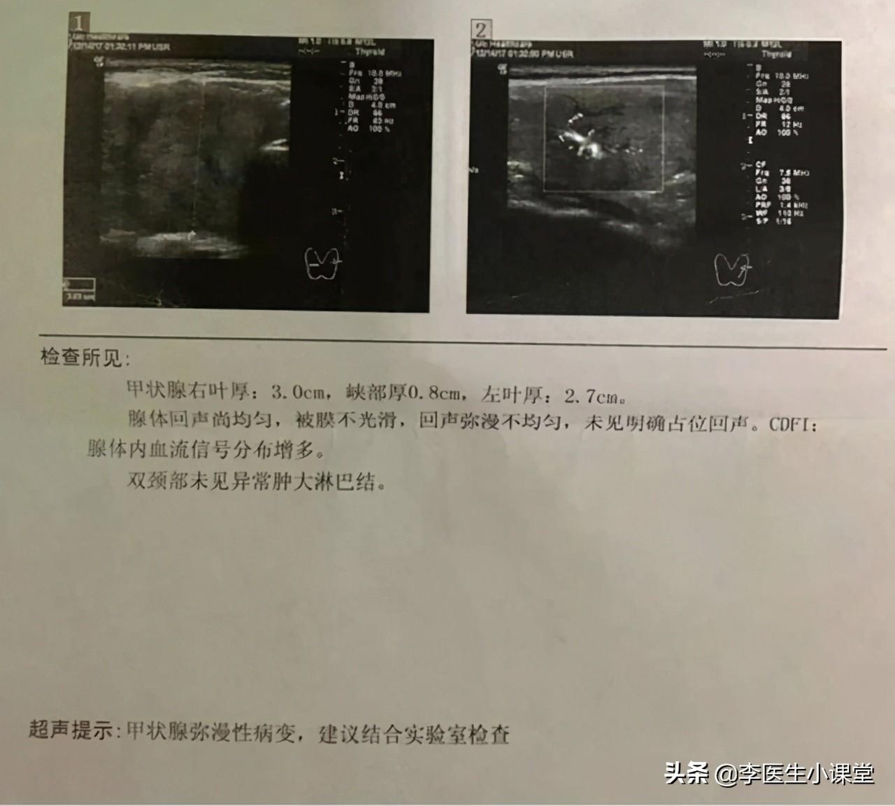 甲亢用补硒嘛有用吗