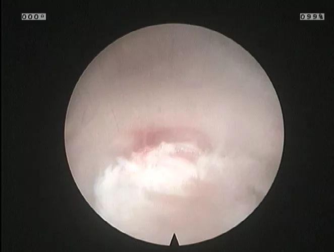 微创手术补硒有用吗