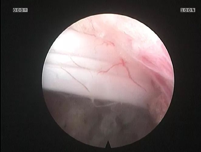 微创手术补硒有用吗