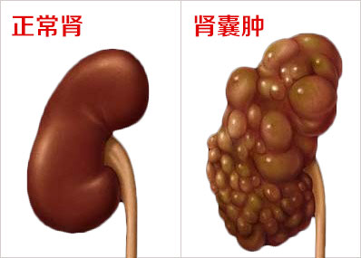补硒对肾囊肿的作用