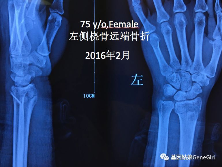 骨折 补钙