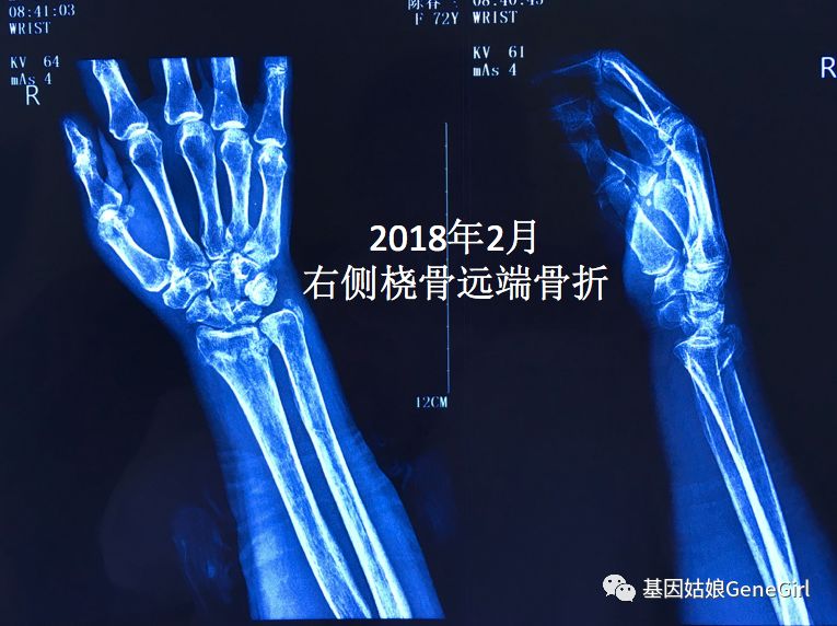 骨折 补钙