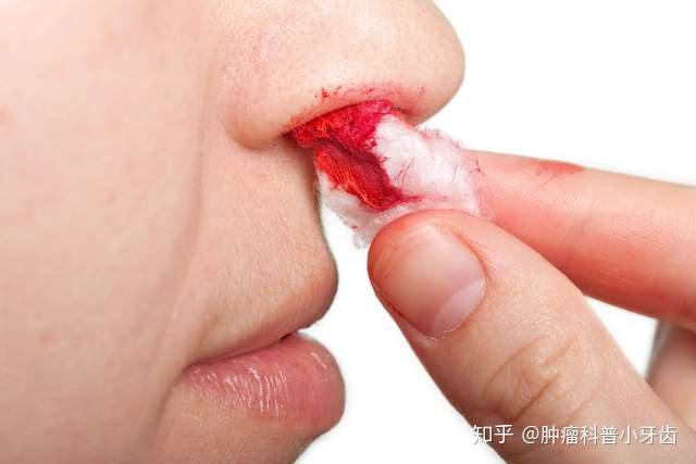 鼻咽癌要补硒吗好吗