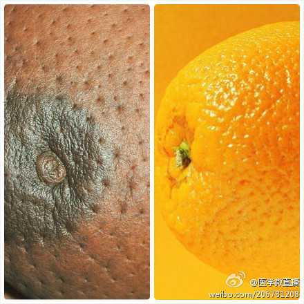 脑动脉瘤可以补硒吗