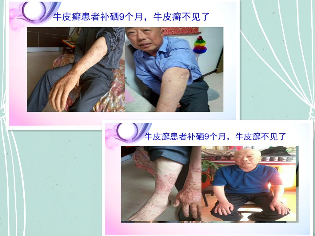 补硒对银屑病有用吗