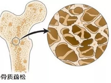 骨质增生需要补钙吗