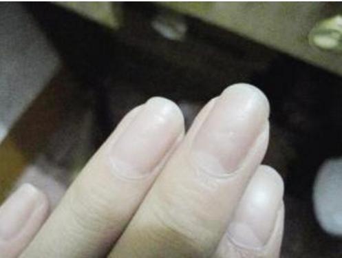 为什么医生看贫血要看指甲，贫血的指甲会有哪些反应？