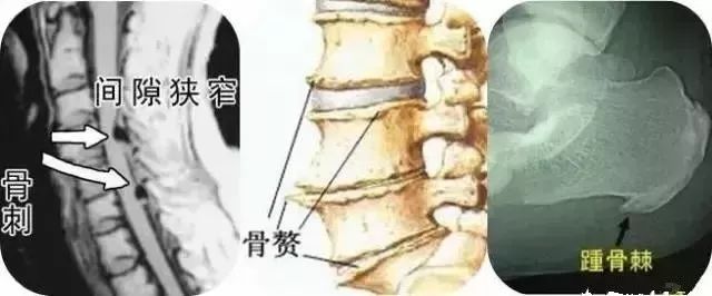 骨质增生需要补钙吗