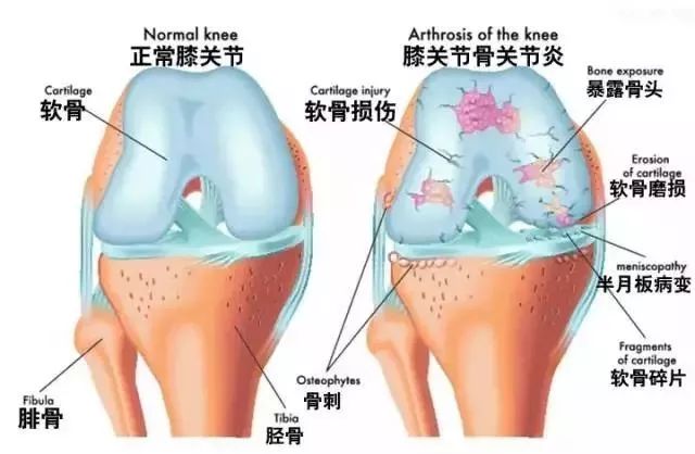 骨质增生需要补钙吗