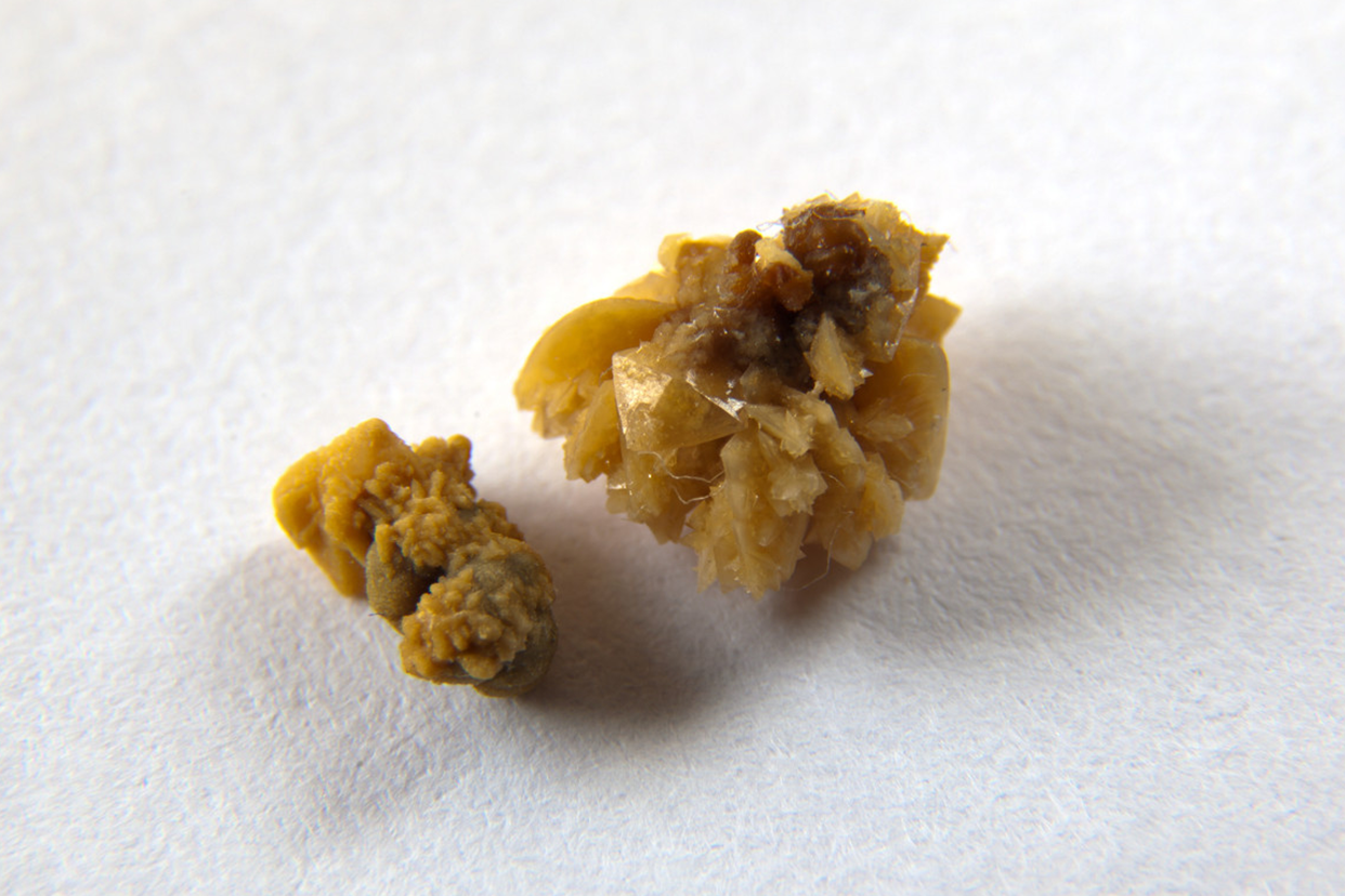 肾结石如何补钙(肾结石补钙会怎么样)-硒宝网