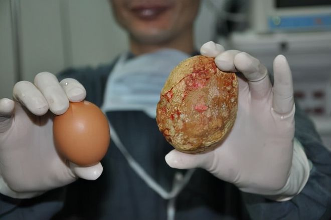 肾结石如何补钙(肾结石补钙会怎么样)-硒宝网