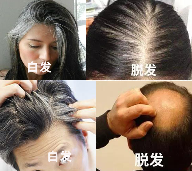 孩子有白头发是缺少什么微量元素