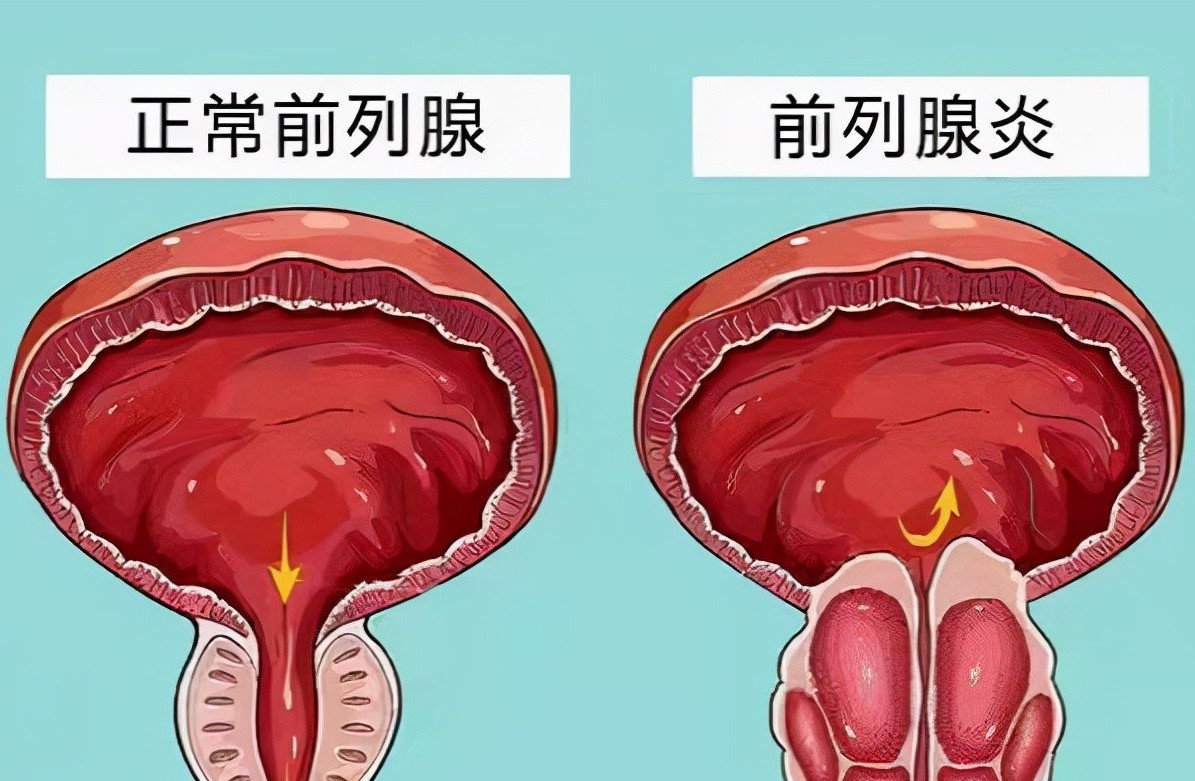 补硒对前列腺炎有效吗