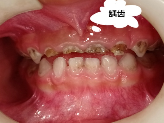 补铁牙齿变黑了怎么办(牙齿变黑补牙)-硒宝网