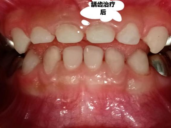 补铁牙齿变黑了怎么办(牙齿变黑补牙)-硒宝网