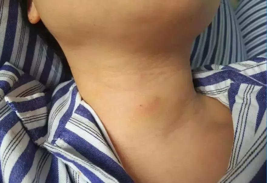 甲状腺癌补硒有什么帮助