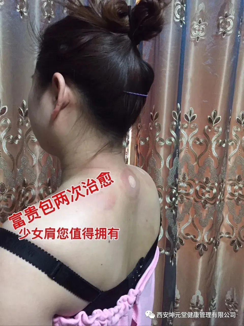 羊毛疔是不是缺硒怎样补