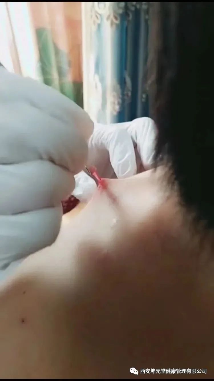 羊毛疔是不是缺硒怎样补
