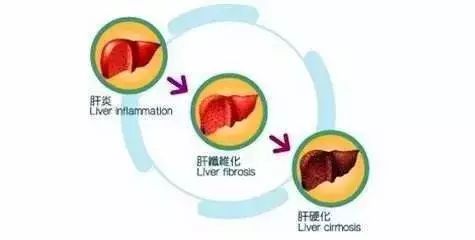 肝硬化病人一天补多少硒