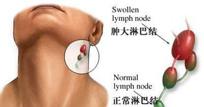 补硒能治疗淋巴结肿大么(硒对淋巴结的效果)-硒宝网
