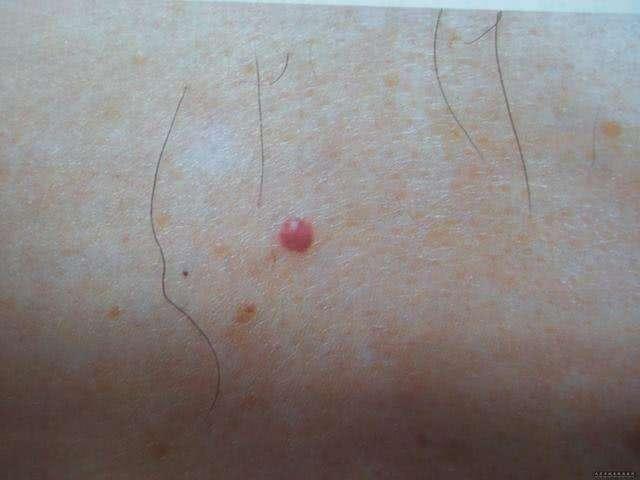 癌细胞入侵肝脏，指甲会有这个“反应”，若没有，说明肝脏很健康