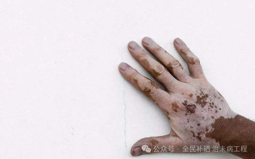 甲亢用不用补硒的维生素(用维生素补甲亢硒可以吗)-硒宝网