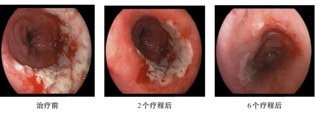 直肠癌能补硒吗中医治疗
