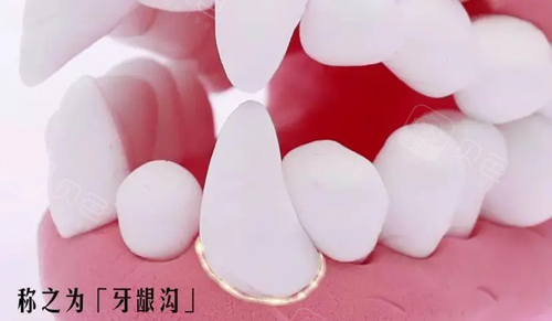 牙龈沟位置图示