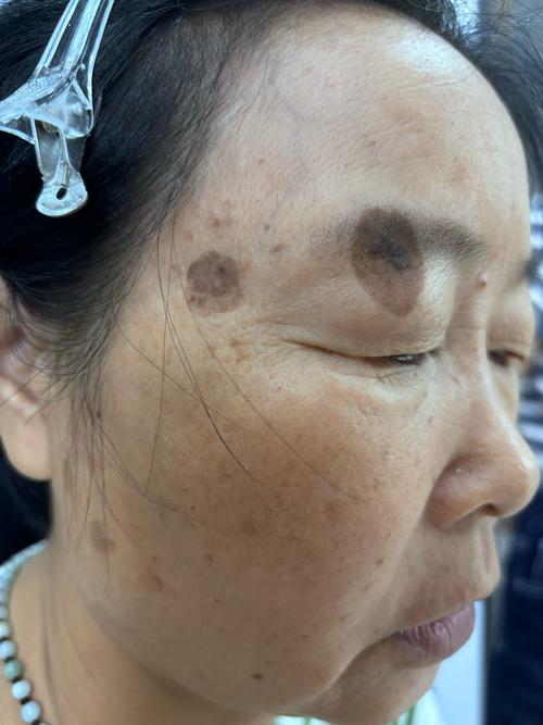 补硒导致长斑