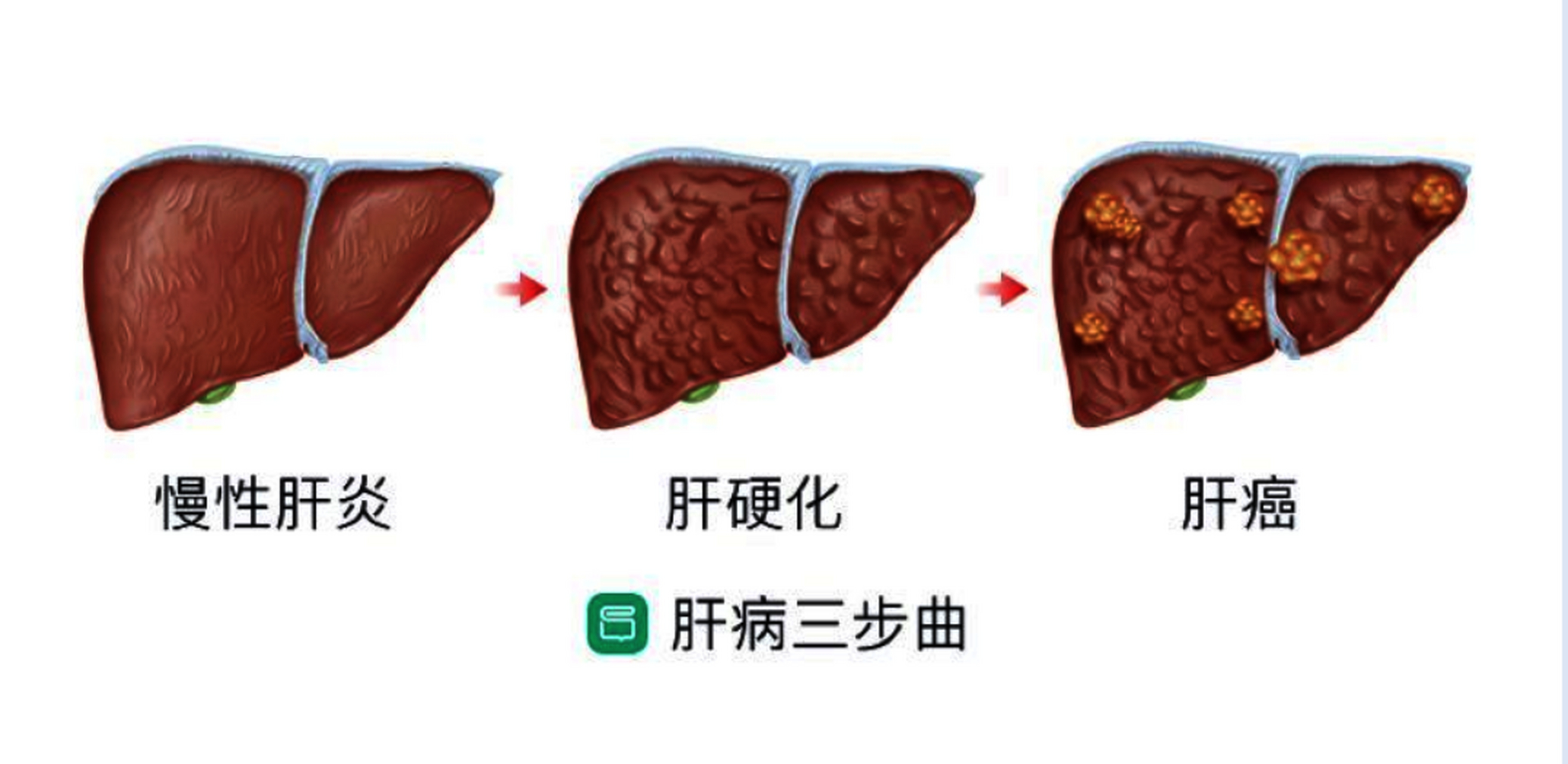 补硒年终总结(硒与肝纤维化关系研究)-硒宝网