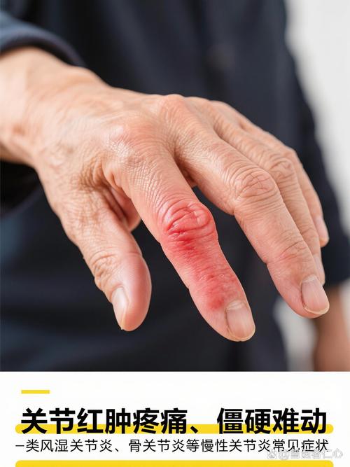 补硒对类风湿（手指类风湿性关节炎吃什么药好）-硒宝网