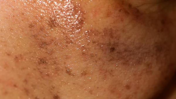 桥本需补硒吗(硒对桥本甲状腺炎的帮助)-硒宝网